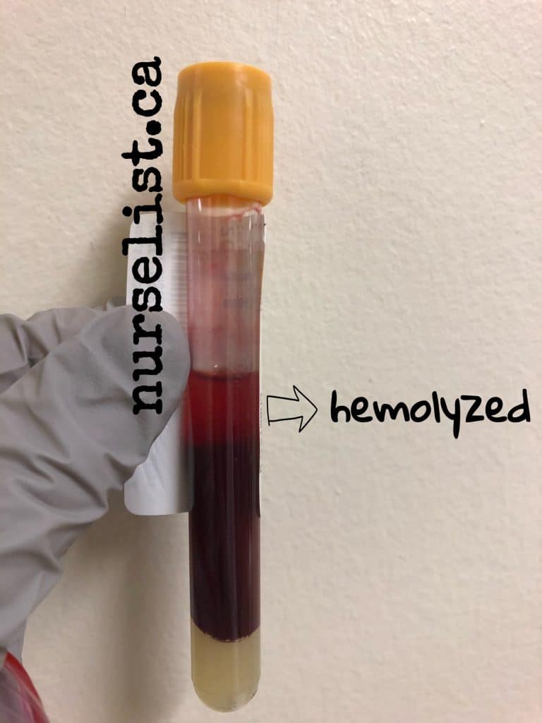 how does a hemolyzed blood sample looks like