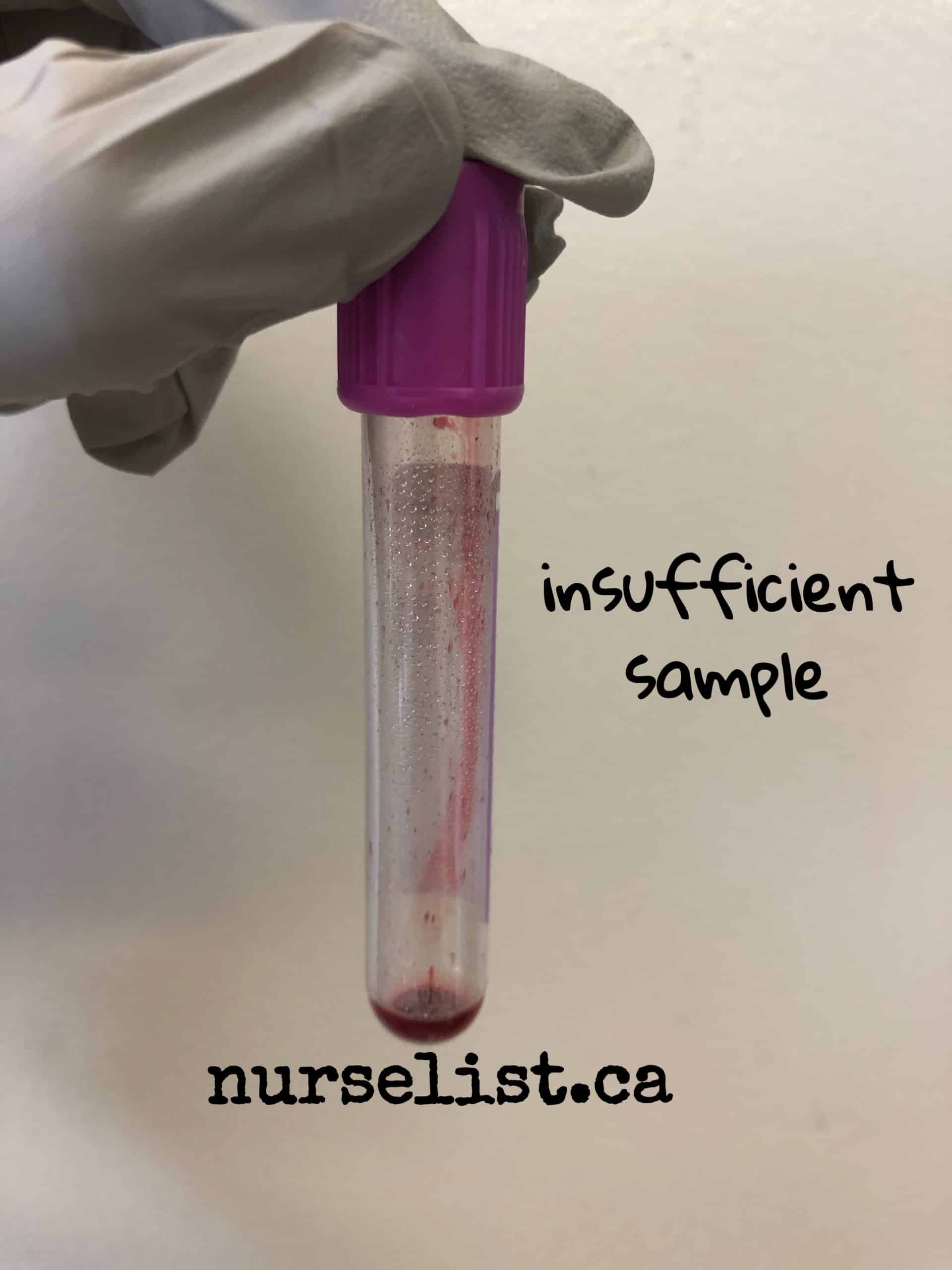 Insufficient Sample 7 Common Mistakes of Nurses When Doing Blood Draws - Nurse List