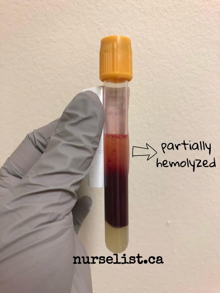 a partially hemolyzed blood sample